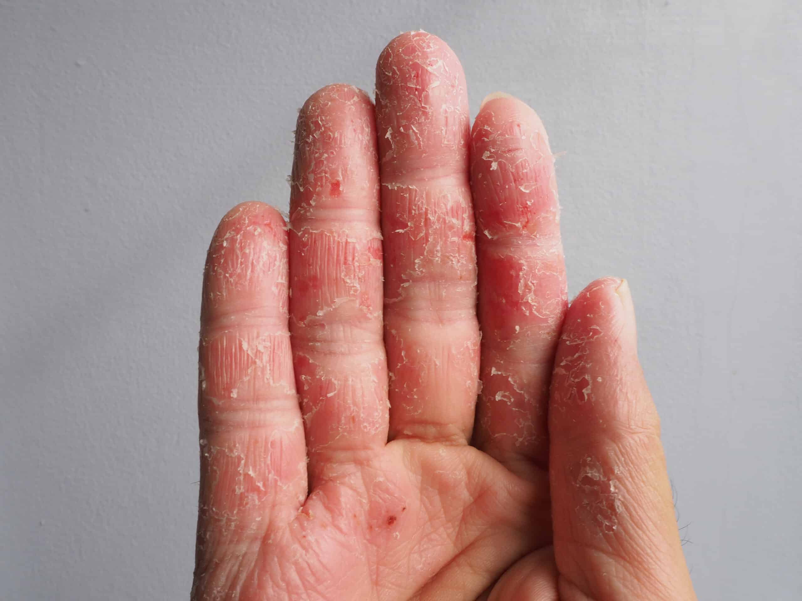 eczema-functional-medicine-services